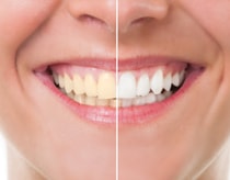 Teeth whitening